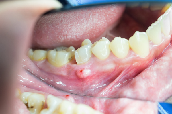Periodontal-disease