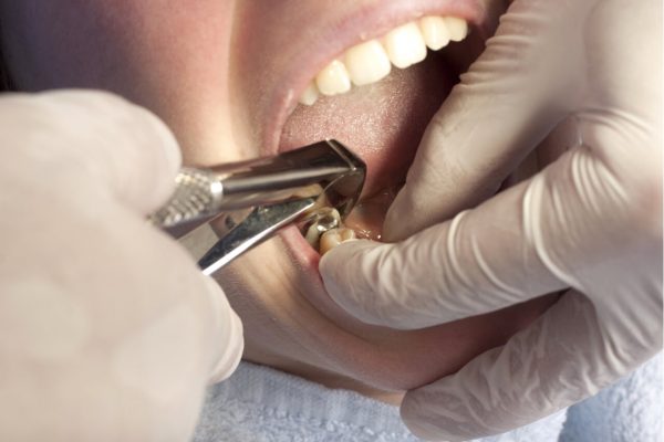 The Need For Tooth Extraction After A Root Canal Failed Drgibberman