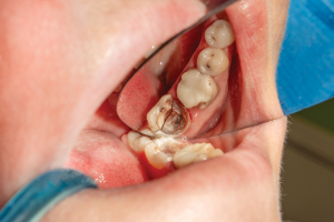 tooth fractures, tooth decay, tooth trauma.