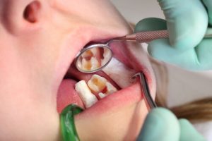 experiencing tooth pain after cavity filling