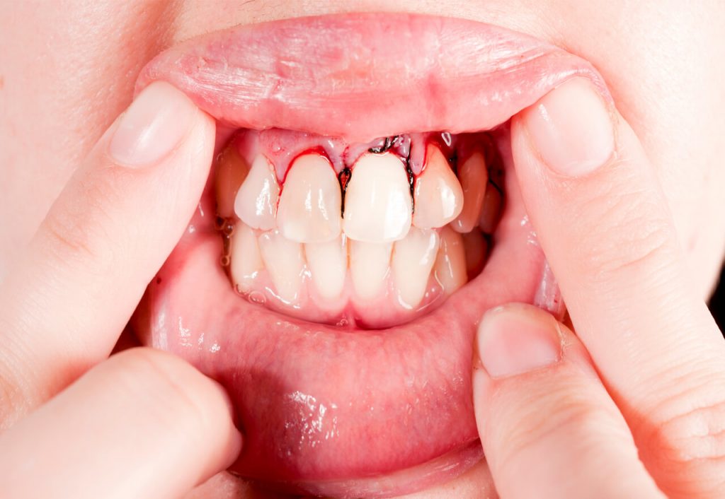 What happens to an untreated tooth abscess Dr. Gibberman