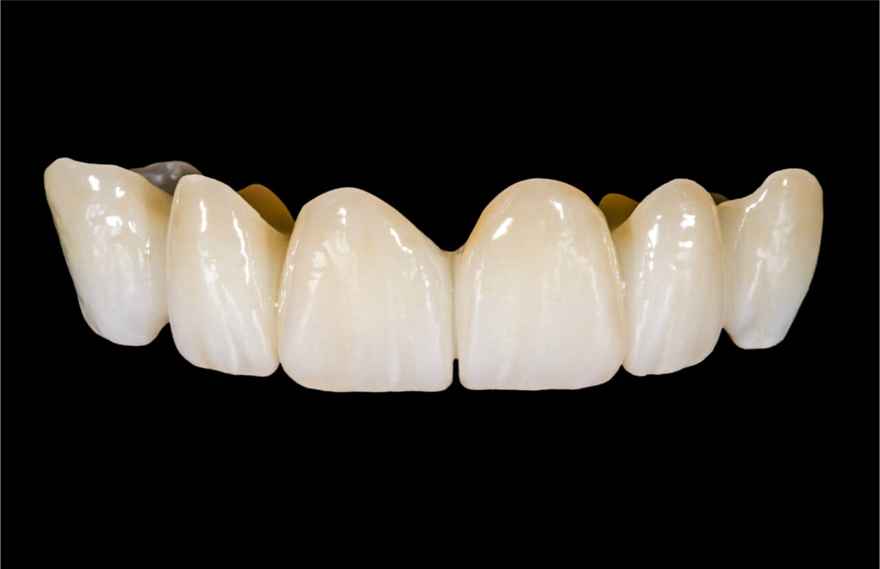 permanent bridge vs removable partial denture