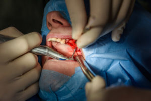 progressive oral surgery