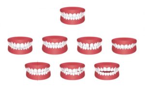 Different kinds of bite problems that braces can work out.